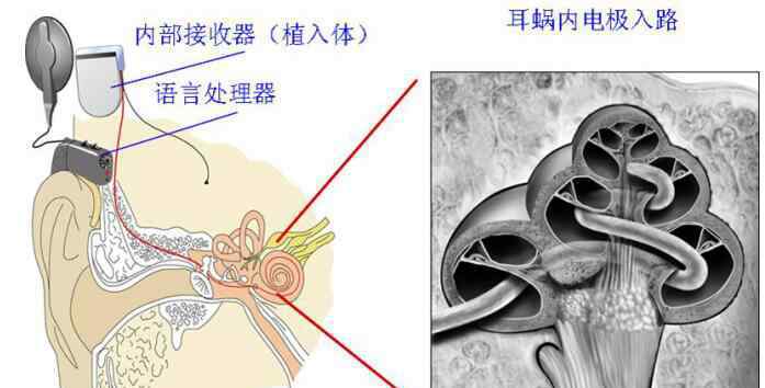 人造耳蜗 专家不建议做人工耳蜗真的吗，人工耳蜗有什么后遗症？