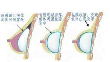 丰胸膜 假体丰胸包膜挛缩你真的了解吗？