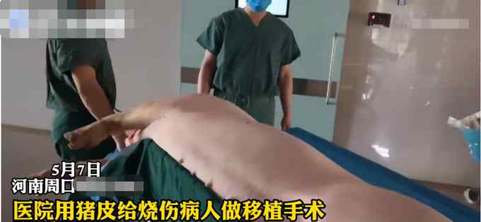 河南一医院为烧伤病人植猪皮 节省20万医疗费 医院：能救命