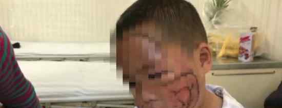 可怜！ 3岁男童脸部惨遭哈士奇撕咬缝合200多针