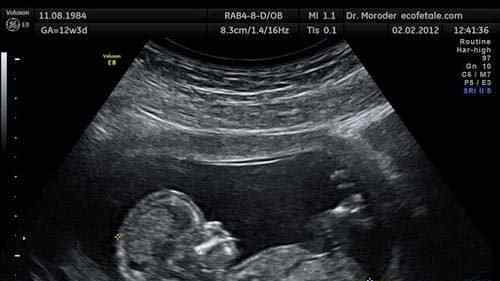 胎儿夭折 孕妇称是超声波检查医生将其敲死