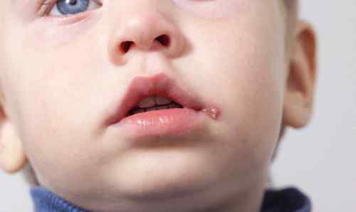 宝宝下巴口水疹图片 分辨宝宝湿疹，口水疹，尿布疹儿童皮疹及各种皮肤状况的特征（附照片慎入）