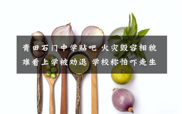青田石门中学贴吧 火灾毁容相貌难看上学被劝退 学校称怕吓走生源文章配图