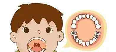 医生说乳牙不用补 口腔医生口中的“人家说”系列之四——乳牙坏了不用补