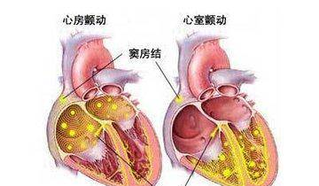 心脏房颤，是怎么回事？该注意什么？进来告诉你。