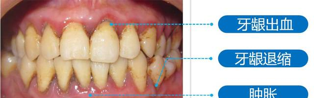 牙龈不健康的几大表现，你中招了吗？