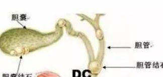 胆结石是怎么形成的，引发胆结石的6个原因，你中了几个？