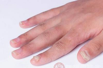 灰指甲的初期症状 这些症状小心灰指甲