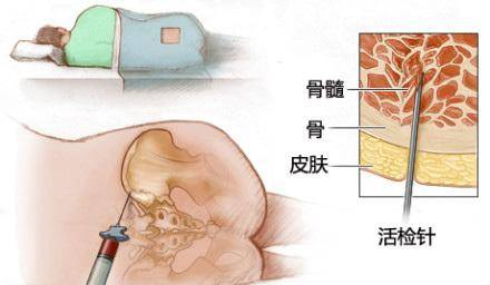 骨髓穿刺术操作规范及训练模型