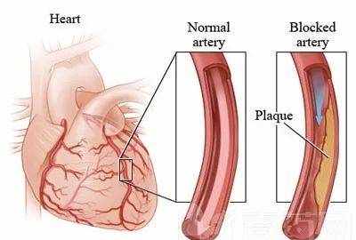 冠心病的3种治疗方法！