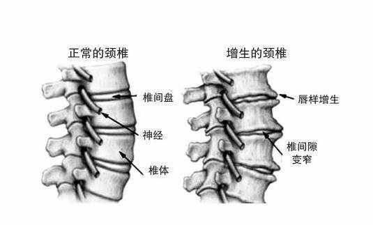 颈椎病引起的头晕，要注意了，可以试试这6种方法！