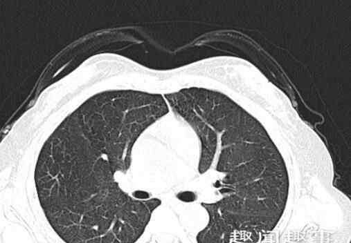 肺部毛玻璃阴影 俩女子没得新冠但肺部CT呈毛玻璃影 医生一查原因无语了