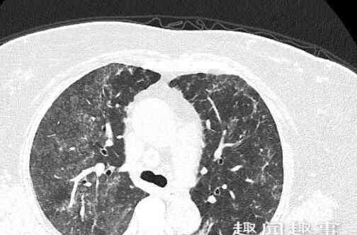 肺部毛玻璃阴影 俩女子没得新冠但肺部CT呈毛玻璃影 医生一查原因无语了