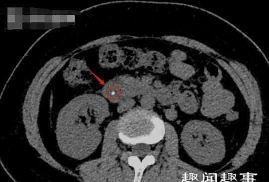 女子小腿取出活虫 广东女子体内取出“活虫”还自由蠕动 只因爱吃这道菜