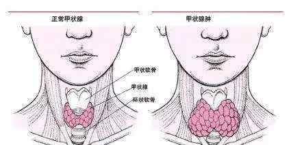 得甲状腺结节 为什么很多人都有甲状腺结节?