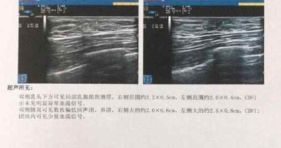 健身3个月胸部发育是什么原因