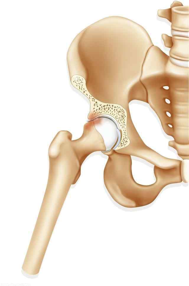 股骨颈骨折并发症 股骨颈骨折的后期并发症：股骨头坏死，为何股骨颈骨折后容易坏死
