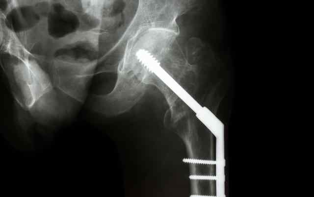 股骨颈骨折并发症 股骨颈骨折的后期并发症：股骨头坏死，为何股骨颈骨折后容易坏死