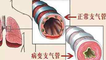 支气管炎传染人吗 有支气管炎的人进行运动，给几点忠告！