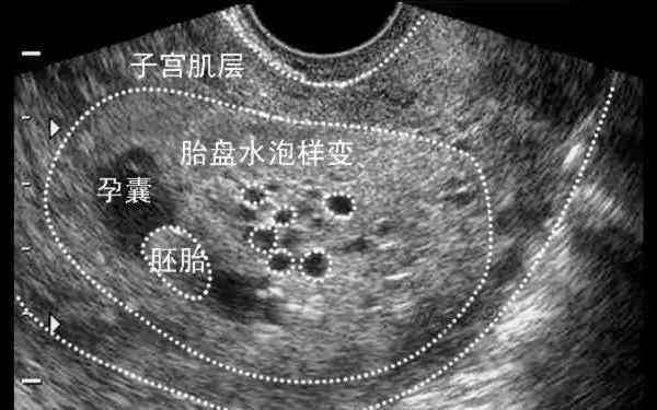 有胎心了孕囊旁有积液 孕囊旁有积液怎么回事？孕囊积液多大必须流产？