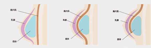 假体植入 假体植入不同层次的对比