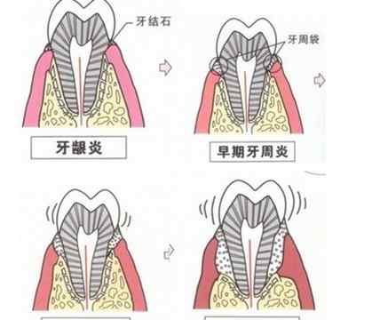 青少年牙周炎 青少年为什么会有牙周炎呢？