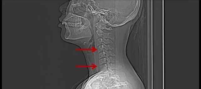 寰椎 颈椎CT天天看，这位27岁上班族的颈椎CT你看懂了吗？