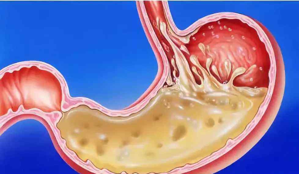 反流性食管炎怎么治疗 反流性食管炎是怎么引起的？西药无效怎么办？