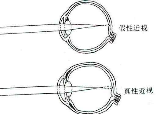 什么是假性近视 什么是假性近视？