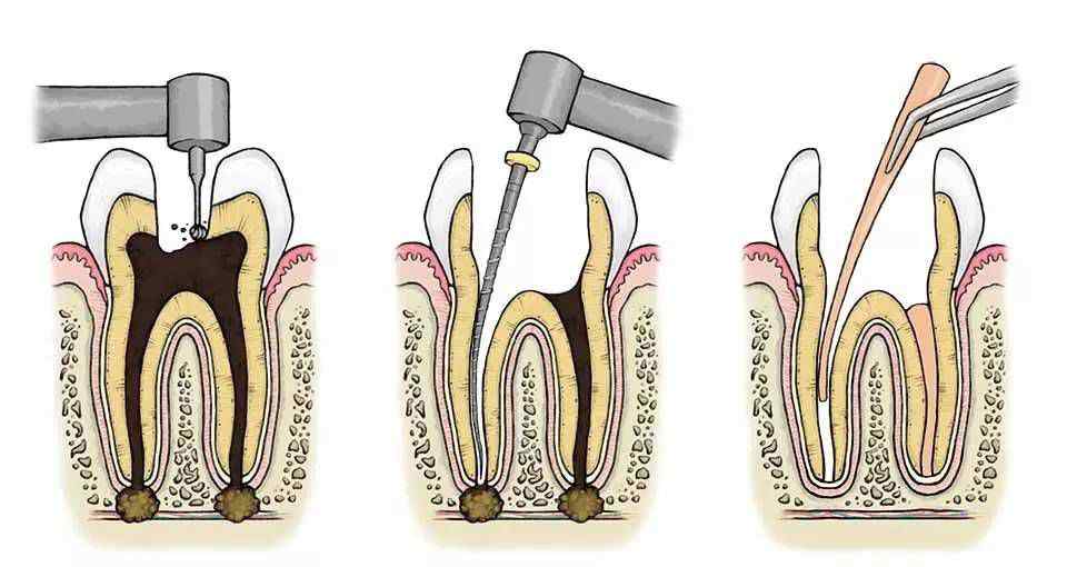 根管治疗哪次最疼 【牙牙之家】根管治疗一次性完成和分次完成哪一个更好？